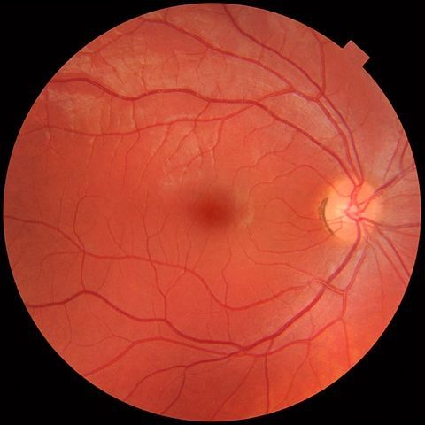 Imagerie d'un fond d'oeil avec son reseau vasculaire